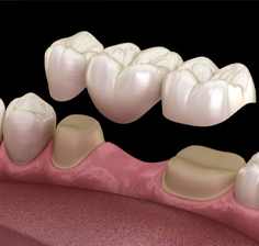پروتز دندان در مطب دکتر پروانه رضایی